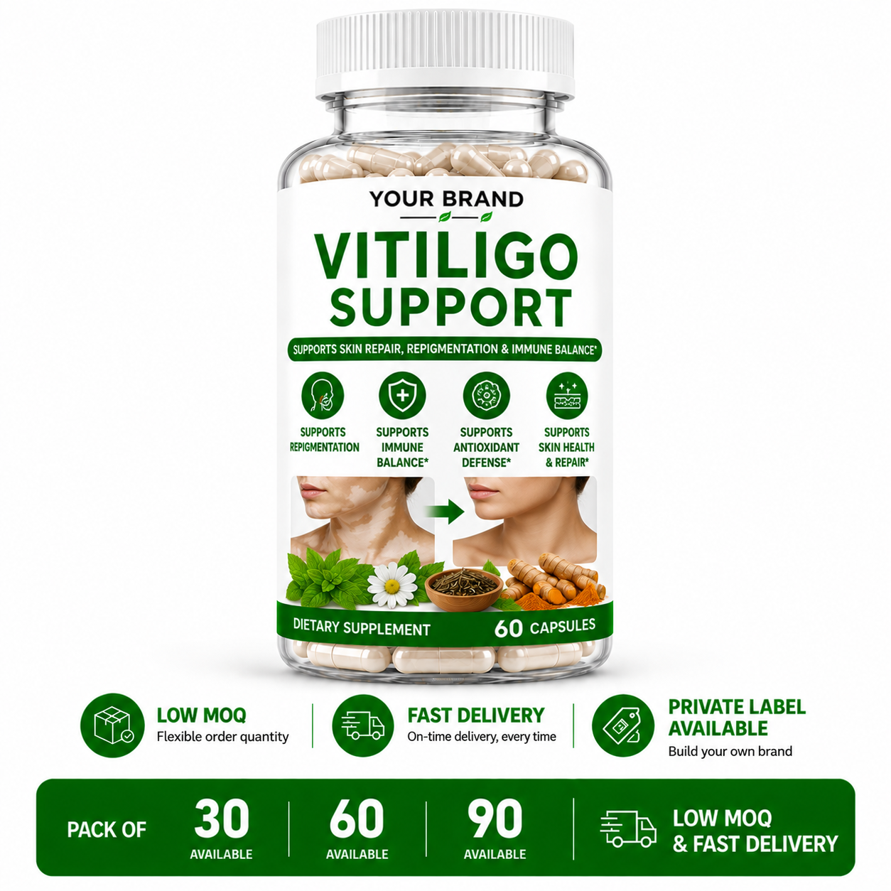 Vitiligo